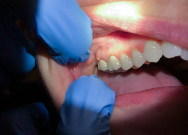 Best Broken or Chipped Tooth Repair in Ridge Wood Heights, FL